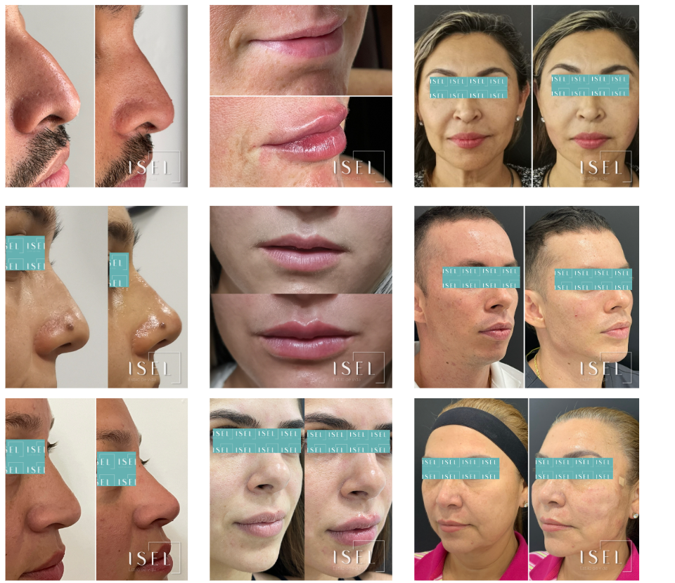 isel-estilo-de-vida-implante-capilar-trasplante-barba-cejas-cabello-caída-alopecia-isel-estilo-de-vida-cali-colombia-usa-estados-unidos-ana-maria-usubillaga-medicina-capilar-terapias-capilares-hair-transplant-medicine-therapy-microinjerto-estilo-de-vida-clínica-fisioterapia-dermatología-dermatologia-piel-cuidado-tratamiento-precio-cuanto-cuesta-estetica-estética-biológica-biologica-funcional-therapy-cali-colombia-miami-orlando-florida-los-angeles-california-new-york-nueva-york-clinic-clinica-medicine-medic-tratamiento-treatment-peeling-limpieza-facial-plasma-peptidos-biomimeticos-microagujas-manchas-pecas-hilos-pdo-botox-acido-hialuronico-fillers-pdo-threads-platelet-rich-biomimetic-peptides-spots-moles-freckles-aesthetic-medicine https://iselestilodevida.com.co/wp-content/uploads/2023/06/hgfdytre.png